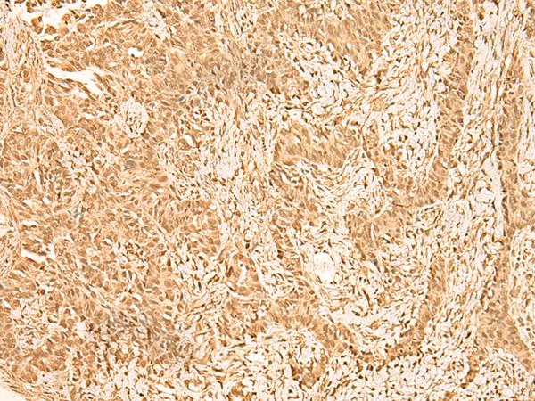 ZNF471 Antibody - Immunohistochemistry of paraffin-embedded Human ovarian cancer tissue  using ZNF471 Polyclonal Antibody at dilution of 1:50(×200)
