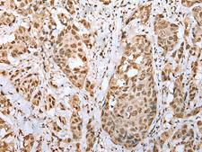 ZNF486 Antibody - Immunohistochemistry of paraffin-embedded Human breast cancer tissue  using ZNF486 Polyclonal Antibody at dilution of 1:50(×200)