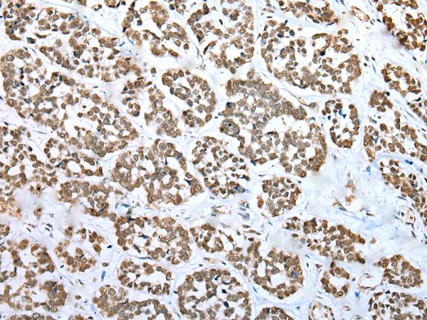 ZNF486 Antibody - Immunohistochemistry of paraffin-embedded Human esophagus cancer tissue  using ZNF486 Polyclonal Antibody at dilution of 1:50(×200)