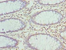 ZNF490 Antibody - Immunohistochemistry of paraffin-embedded human colon cancer using ZNF490 Antibody at dilution of 1:100