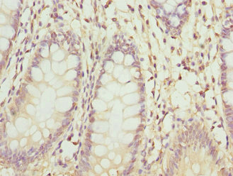 ZNF544 Antibody - Immunohistochemistry of paraffin-embedded human colon cancer at dilution 1:100
