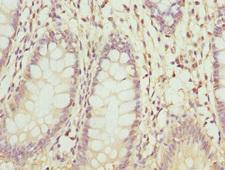 ZNF544 Antibody - Immunohistochemistry of paraffin-embedded human colon cancer at dilution 1:100