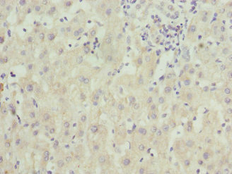 ZNF544 Antibody - Immunohistochemistry of paraffin-embedded human liver cancer at dilution 1:100