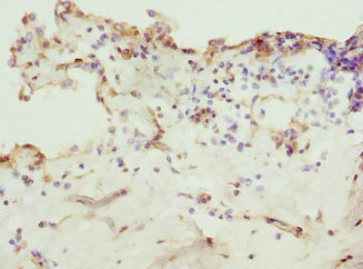 ZNF549 Antibody - Immunohistochemistry of paraffin-embedded human breast cancer at dilution 1:100