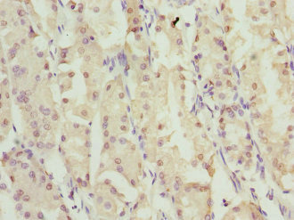 ZNF549 Antibody - Immunohistochemistry of paraffin-embedded human gastric cancer at dilution 1:100