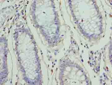 ZNF555 Antibody - Immunohistochemistry of paraffin-embedded human colon cancer using antibody at dilution of 1:100.