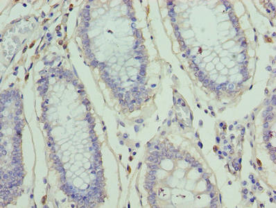 ZNF555 Antibody - Immunohistochemistry of paraffin-embedded human colon cancer using ZNF555 Antibody at dilution of 1:100