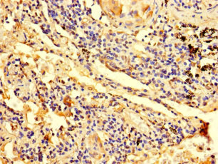 ZNF559 Antibody - Immunohistochemistry of paraffin-embedded human lung cancer using ZNF559 Antibody at dilution of 1:100