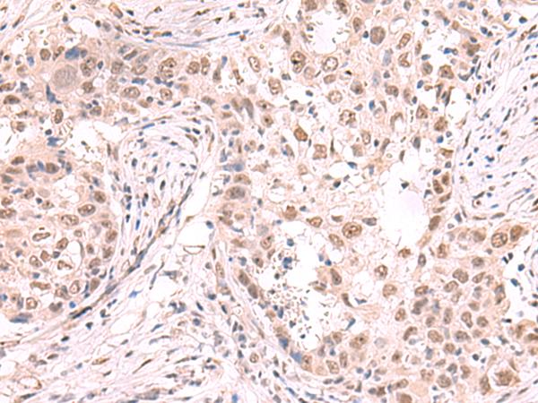 ZNF559 Antibody - Immunohistochemistry of paraffin-embedded Human esophagus cancer tissue  using ZNF559 Polyclonal Antibody at dilution of 1:80(×200)