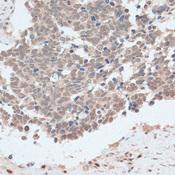 ZNF562 Antibody - Immunohistochemistry of paraffin-embedded Human lung cancer using ZNF562 Polyclonal Antibody at dilution of 1:100 (40x lens).