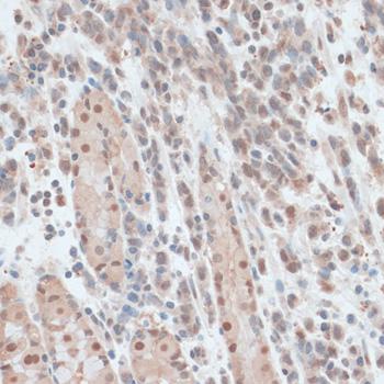 ZNF562 Antibody - Immunohistochemistry of paraffin-embedded Human gastric cancer using ZNF562 Polyclonal Antibody at dilution of 1:100 (40x lens).