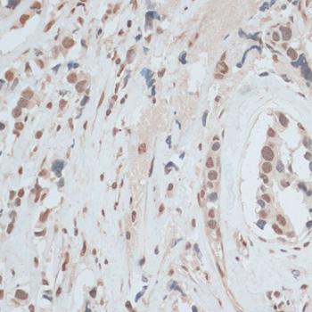 ZNF574 Antibody - Immunohistochemistry of paraffin-embedded Human breast cancer using ZNF574 Polyclonal Antibody at dilution of 1:100 (40x lens).