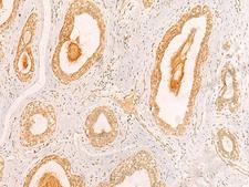 ZNF580 Antibody - Immunohistochemistry of paraffin-embedded Human breast cancer tissue  using ZNF580 Polyclonal Antibody at dilution of 1:40(×200)