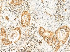 ZNF580 Antibody - Immunohistochemistry of paraffin-embedded Human esophagus cancer tissue  using ZNF580 Polyclonal Antibody at dilution of 1:75(×200)