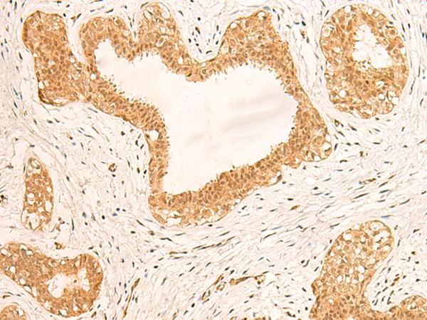 ZNF580 Antibody - Immunohistochemistry of paraffin-embedded Human breast cancer tissue  using ZNF580 Polyclonal Antibody at dilution of 1:75(×200)