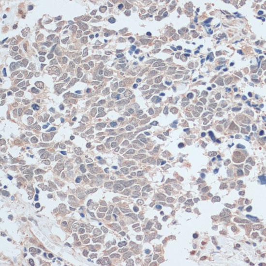 ZNF581 Antibody - Immunohistochemistry of paraffin-embedded Human lung cancer using ZNF581 Polyclonal Antibody at dilution of 1:100 (40x lens).