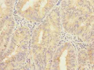 ZNF582 Antibody - Immunohistochemistry of paraffin-embedded human endometrial cancer using ZNF582 Antibody at dilution of 1:100