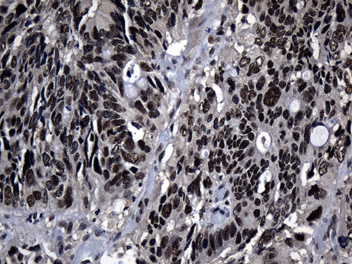 ZNF583 Antibody - Immunohistochemical staining of paraffin-embedded Adenocarcinoma of Human colon tissue using anti-ZNF583 mouse monoclonal antibody. (Heat-induced epitope retrieval by 1mM EDTA in 10mM Tris buffer. (pH8.5) at 120°C for 3 min. (1:500)