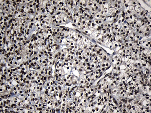 ZNF583 Antibody - Immunohistochemical staining of paraffin-embedded Carcinoma of Human kidney tissue using anti-ZNF583 mouse monoclonal antibody. (Heat-induced epitope retrieval by 1mM EDTA in 10mM Tris buffer. (pH8.5) at 120°C for 3 min. (1:150)