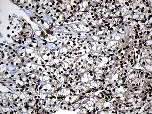 ZNF583 Antibody - Immunohistochemical staining of paraffin-embedded Carcinoma of Human kidney tissue using anti-ZNF583 mouse monoclonal antibody. (Heat-induced epitope retrieval by 1mM EDTA in 10mM Tris buffer. (pH8.5) at 120°C for 3 min. (1:500)