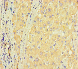 ZNF583 Antibody - Immunohistochemistry of paraffin-embedded human liver cancer using ZNF583 Antibody at dilution of 1:100