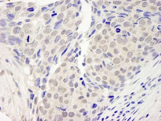 ZNF592 Antibody - Detection of Human ZNF592 by Immunohistochemistry. Sample: FFPE section of human breast carcinoma. Antibody: Affinity purified rabbit anti-ZNF592 used at a dilution of 1:250.