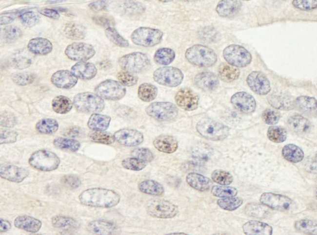 ZNF592 Antibody - Detection of Human ZNF592 by Immunohistochemistry. Sample: FFPE section of human prostate carcinoma. Antibody: Affinity purified rabbit anti-ZNF592 used at a dilution of 1:250.