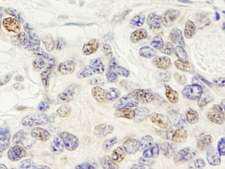 ZNF592 Antibody - Detection of Human ZNF592 by Immunohistochemistry. Sample: FFPE section of human ovarian carcinoma. Antibody: Affinity purified rabbit anti-ZNF592 used at a dilution of 1:1000 (1 ug/ml). Detection: DAB.