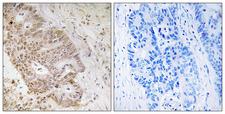 ZNF592 Antibody - Immunohistochemistry analysis of paraffin-embedded human colon carcinoma tissue, using ZNF592 Antibody. The picture on the right is blocked with the synthesized peptide.