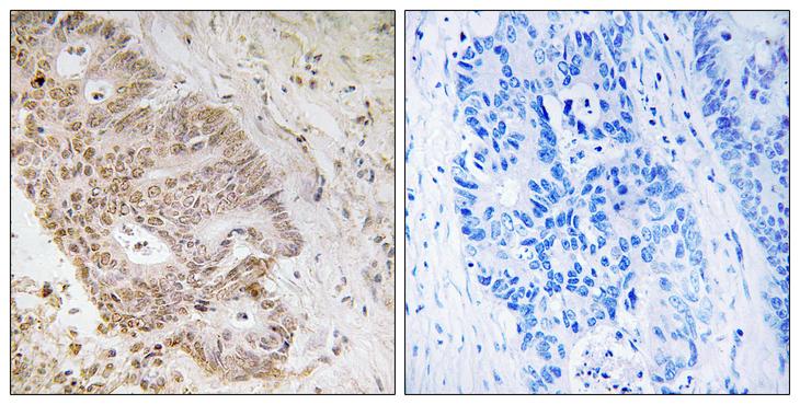 ZNF592 Antibody - Peptide - + Immunohistochemistry analysis of paraffin-embedded human colon carcinoma tissue, using ZNF592 antibody.