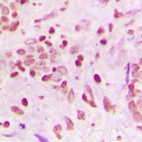 ZNF608 Antibody - Immunohistochemical analysis of ZNF608 staining in human breast cancer formalin fixed paraffin embedded tissue section. The section was pre-treated using heat mediated antigen retrieval with sodium citrate buffer (pH 6.0). The section was then incubated with the antibody at room temperature and detected using an HRP conjugated compact polymer system. DAB was used as the chromogen. The section was then counterstained with hematoxylin and mounted with DPX.
