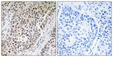 ZNF608 Antibody - Peptide - + Immunohistochemistry analysis of paraffin-embedded human lung carcinoma tissue using ZNF608 antibody.