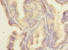 ZNF614 Antibody - Immunohistochemistry of paraffin-embedded human prostate cancer using antibody at dilution of 1:100.