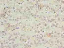 ZNF622 Antibody - Immunohistochemistry of paraffin-embedded human liver cancer using antibody at dilution of 1:100.