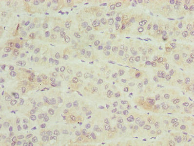 ZNF622 Antibody - Immunohistochemistry of paraffin-embedded human liver cancer using ZNF622 Antibody at dilution of 1:100
