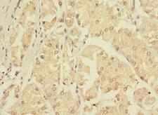ZNF624 Antibody - Immunohistochemistry of paraffin-embedded human gastric cancer using ZNF624 Antibody at dilution of 1:100