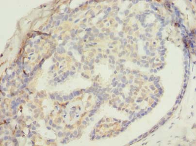 ZNF626 Antibody - Immunohistochemistry of paraffin-embedded human breast cancer using antibody at dilution of 1:100.