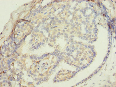 ZNF626 Antibody - Immunohistochemistry of paraffin-embedded human breast cancer using ZNF626 Antibody at dilution of 1:100