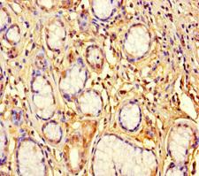 ZNF627 Antibody - Immunohistochemistry of paraffin-embedded human gastric cancer using ZNF627 Antibody at dilution of 1:100