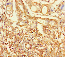 ZNF627 Antibody - Immunohistochemistry of paraffin-embedded human pancreatic cancer using ZNF627 Antibody at dilution of 1:100