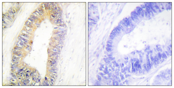 ZNF638 Antibody - Immunohistochemistry analysis of paraffin-embedded human colon carcinoma tissue, using ZNF638 Antibody. The picture on the right is blocked with the synthesized peptide.