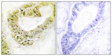 ZNF638 Antibody - Peptide - + Immunohistochemistry analysis of paraffin-embedded human colon carcinoma tissue using ZNF638 antibody.