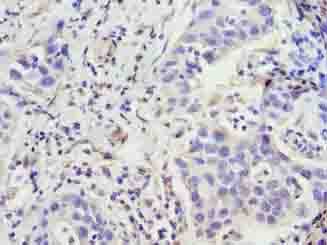 ZNF643 Antibody - Immunohistochemistry of paraffin-embedded human bladder carcinoma using antibody at dilution of 1:100.