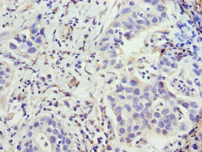 ZNF643 Antibody - Immunohistochemistry of paraffin-embedded human bladder cancer using ZFP69B Antibody at dilution of 1:100