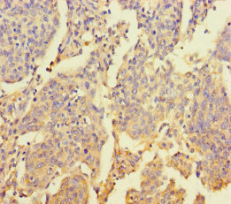 ZNF662 Antibody - Immunohistochemistry of paraffin-embedded human cervical cancer using ZNF662 Antibody at dilution of 1:100