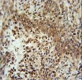ZNF667 / MIPU1 Antibody - ZNF667 Antibody immunohistochemistry of formalin-fixed and paraffin-embedded human lung carcinoma followed by peroxidase-conjugated secondary antibody and DAB staining.