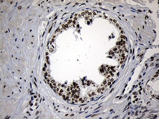 ZNF670 Antibody - Immunohistochemical staining of paraffin-embedded Carcinoma of Human prostate tissue using anti-ZNF670 mouse monoclonal antibody. (Heat-induced epitope retrieval by 1mM EDTA in 10mM Tris buffer. (pH8.5) at 120°C for 3 min. (1:500)
