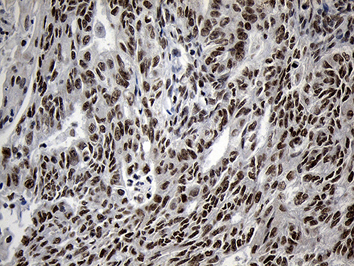 ZNF670 Antibody - Immunohistochemical staining of paraffin-embedded Adenocarcinoma of Human endometrium tissue using anti-ZNF670 mouse monoclonal antibody. (Heat-induced epitope retrieval by 1mM EDTA in 10mM Tris buffer. (pH8.5) at 120°C for 3 min. (1:500)