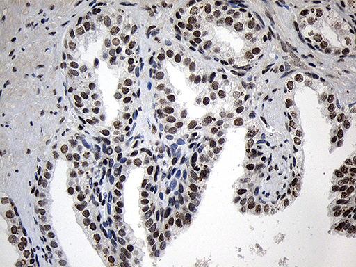ZNF670 Antibody - Immunohistochemical staining of paraffin-embedded Carcinoma of Human prostate tissue using anti-ZNF670 mouse monoclonal antibody. (Heat-induced epitope retrieval by 1mM EDTA in 10mM Tris buffer. (pH8.5) at 120°C for 3 min. (1:500)