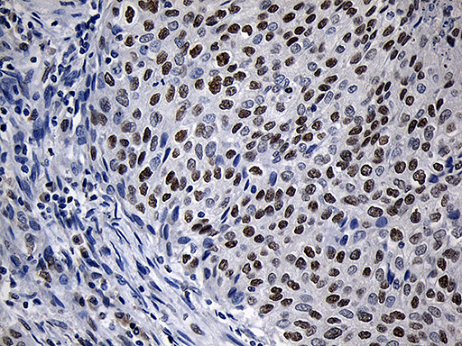 ZNF670 Antibody - Immunohistochemical staining of paraffin-embedded Carcinoma of Human bladder tissue using anti-ZNF670 mouse monoclonal antibody. (Heat-induced epitope retrieval by 1mM EDTA in 10mM Tris buffer. (pH8.5) at 120°C for 3 min. (1:500)